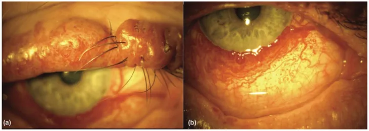 phakomatoses sturge weber eyelid conjunctival photo