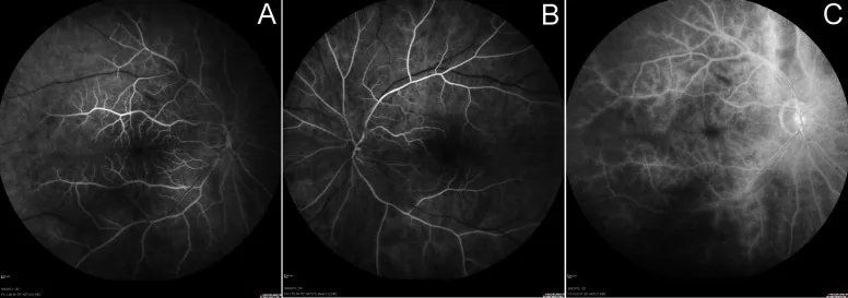 subclavian steal syndrome fluorescein angiography