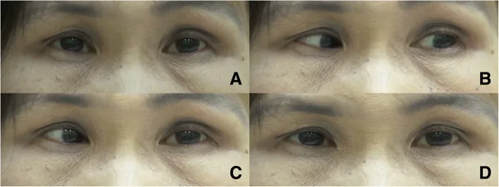 ocular neuromyotonia induced adduction
