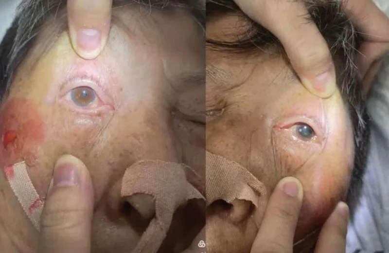 Photographie clinique d'une paralysie du nerf oculomoteur. On observe un ptosis palpébral et une mydriase unilatéraux.