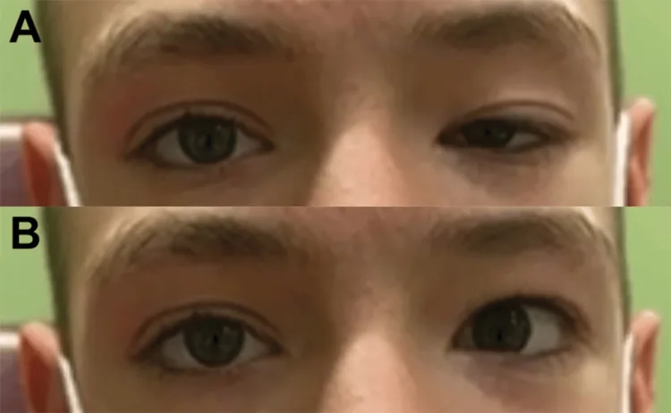 oculomotor synkinesis marcus gunn jaw winking