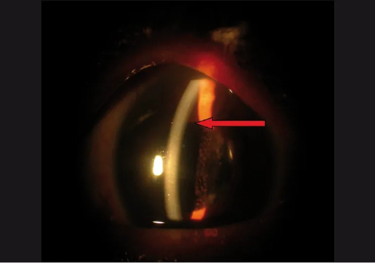 systemic capillary leak syndrome deep anterior chamber