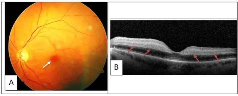 heparin induced thrombocytopenia cherry red spot oct