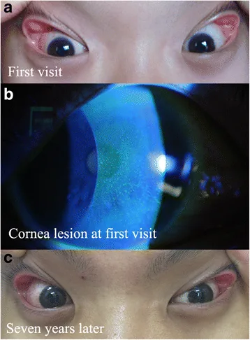 obstructive sleep apnea floppy eyelid corneal staining