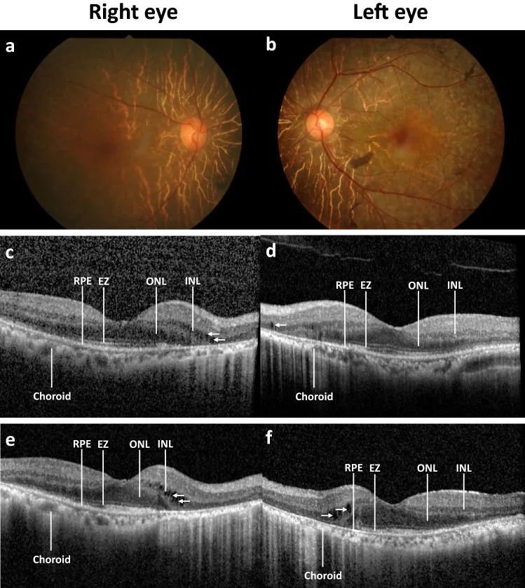 paraneoplastic autoimmune retinopathy fundus oct series