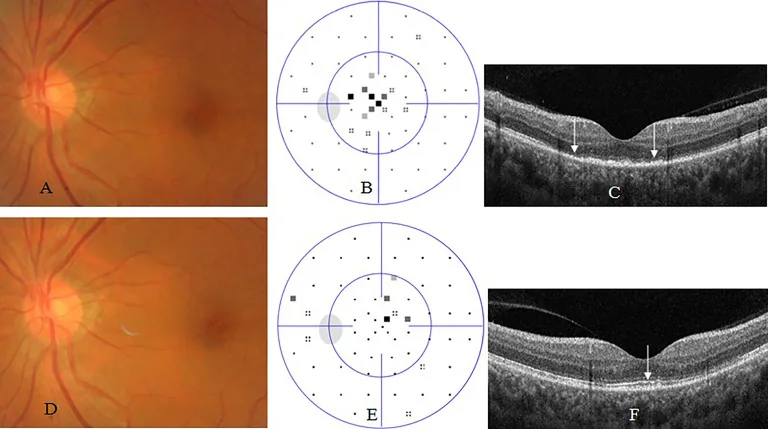 syphilitic retinitis fundus oct