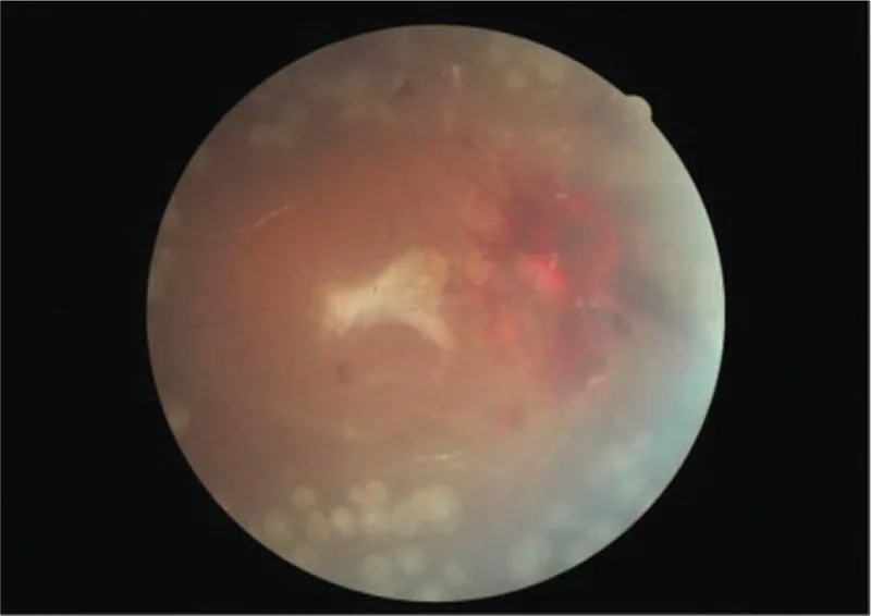 ttp postoperative disc hemorrhage fundus