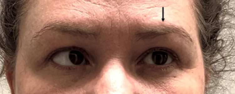 painful ophthalmoplegic neuropathy abduction deficit