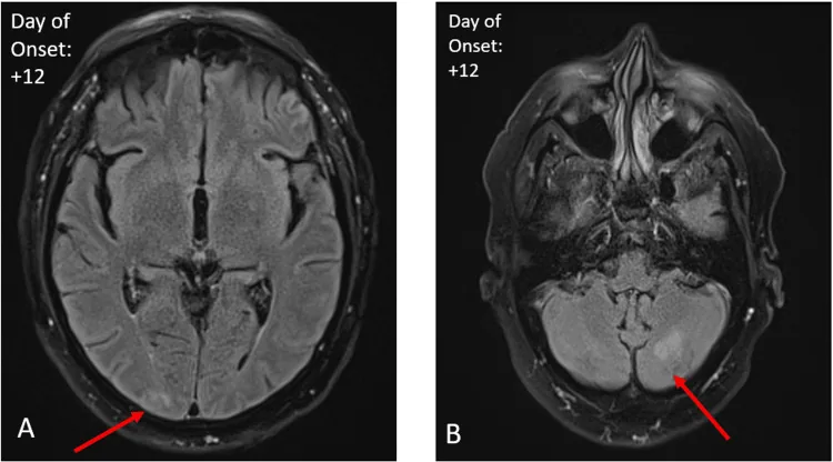 تصویر MRI مغز در سندرم اپسوکلونوس-میوکلونوس