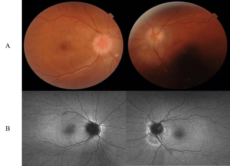 optic nerve sheath decompression bilateral disc edema