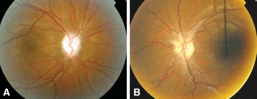optic nerve sheath meningioma disc pallor