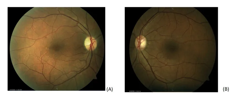 post covid optic neuropathy bilateral fundus