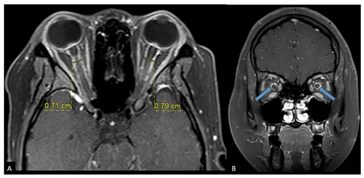 optic perineuritis gadolinium mri
