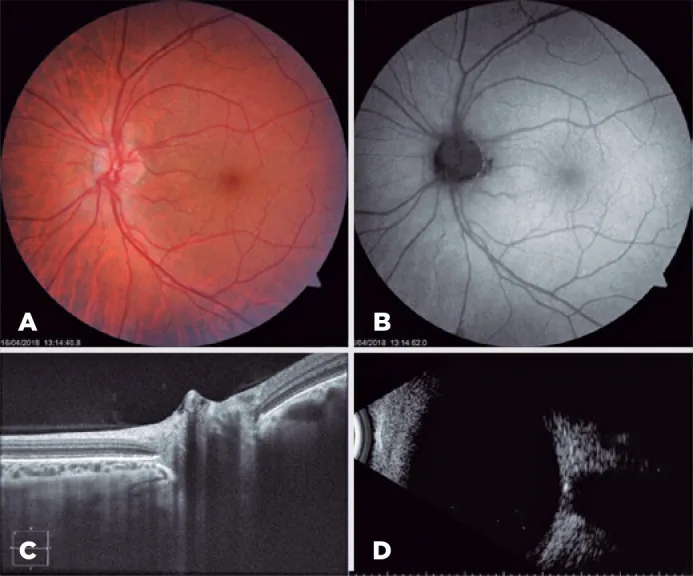 neuro ophthalmology oct multimodal example
