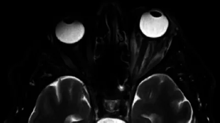 orbital apex syndrome orbital mri