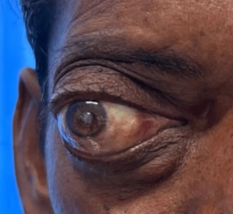 眼窩腫瘍による右眼の眼球突出。眼球が前方に押し出され、瞳の位置が下外方にずれている外眼部写真。