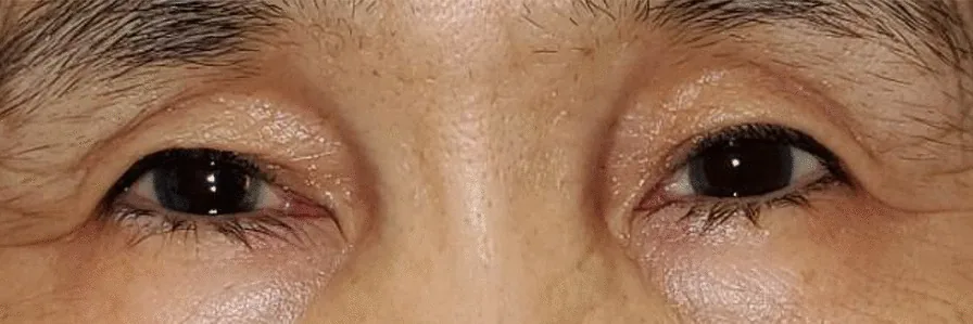 oxymetazoline ptosis improvement after treatment