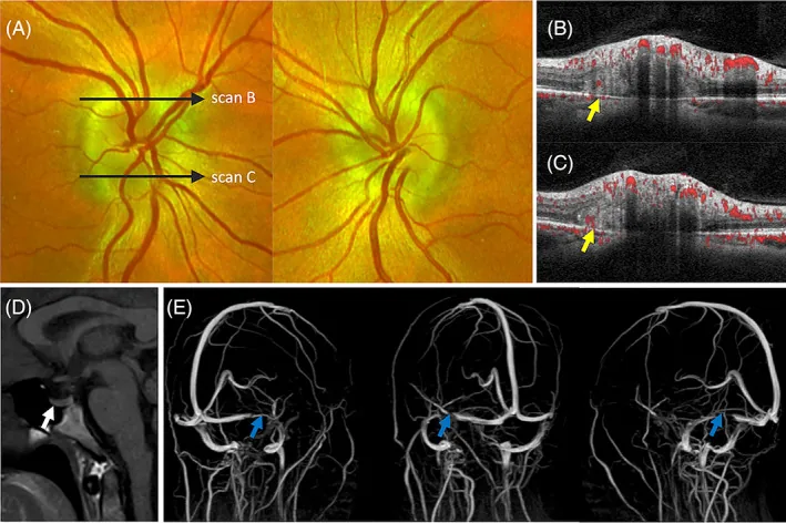 papilledema phoms oct fundus