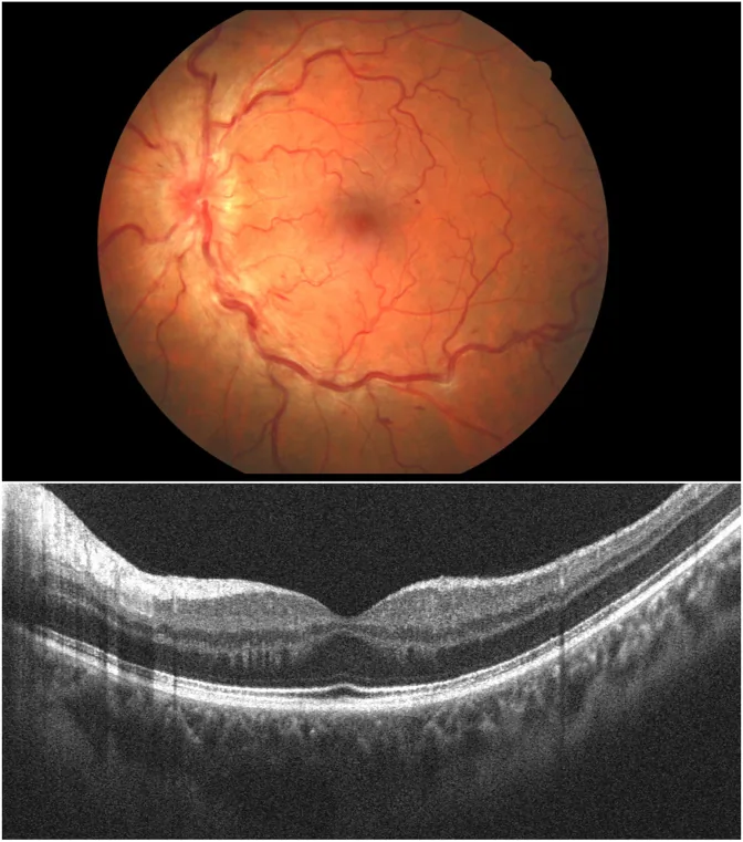 papillophlebitis fundus macular oct