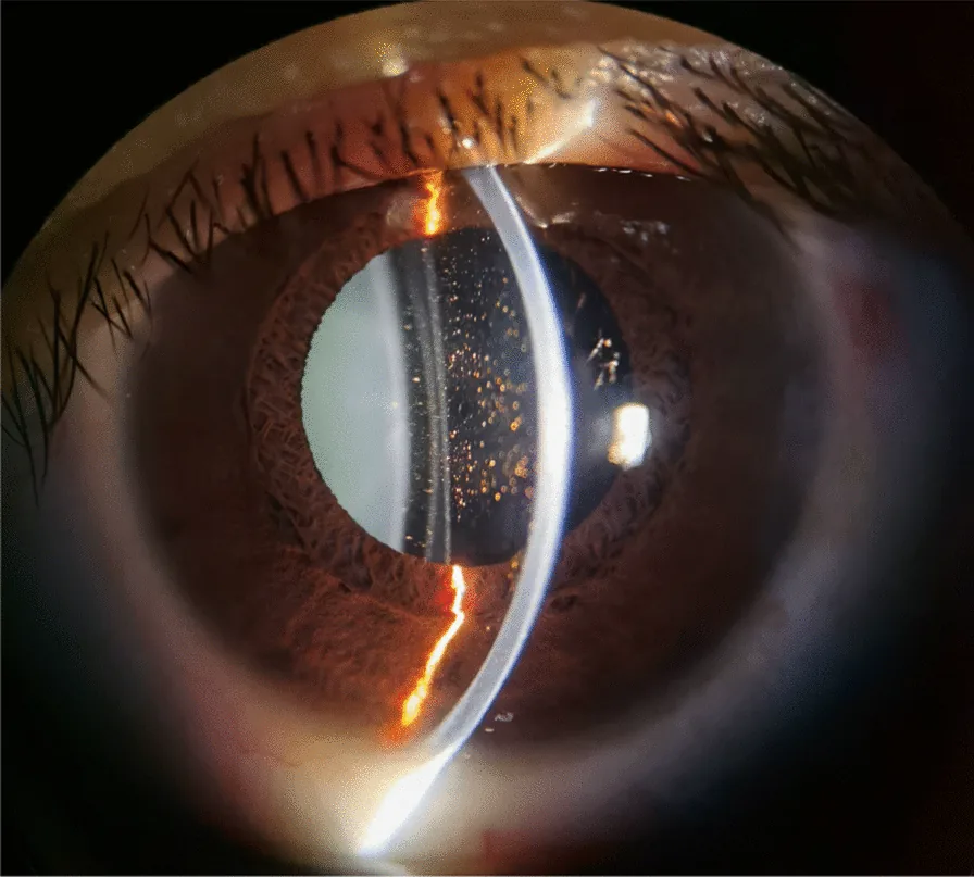 pharmacologic mydriasis fixed dilated pupil slitlamp