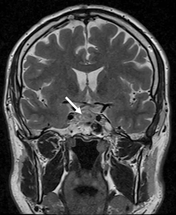 トルコ鞍から上方に膨らむ下垂体腺腫を白い矢印で示した頭部MRIの冠状断(T2強調画像)。