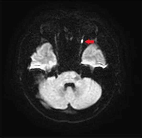 posterior ischemic optic neuropathy dwi mri