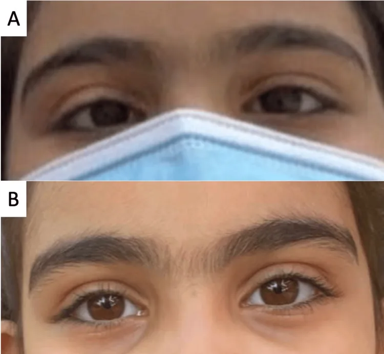 postoperative decompensated strabismus before after