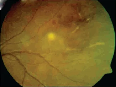 primary cns vasculitis occlusive retinal vasculitis