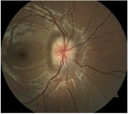pseudopapilledema superficial disc drusen