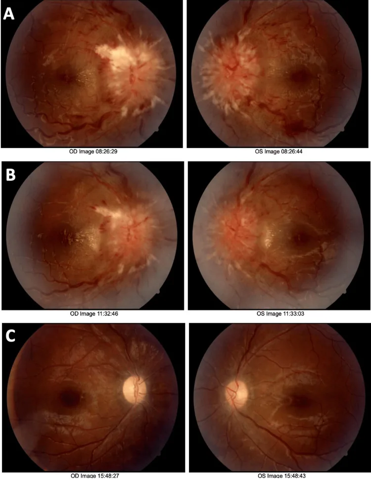 pseudotumor cerebri papilledema follow up fundus