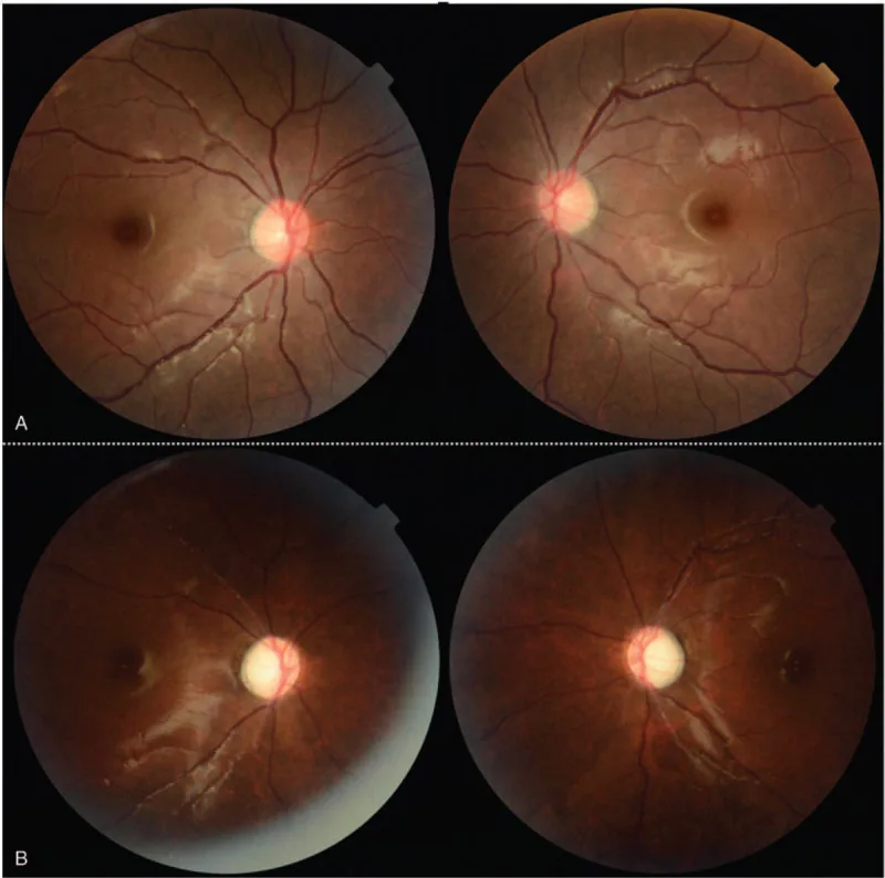 radiation optic neuropathy disc pallor series