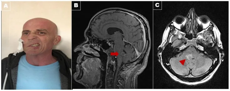 raymond syndrome face and brainstem mri