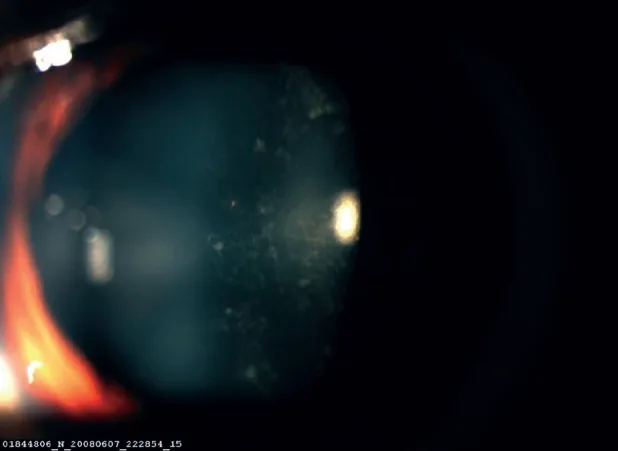 reverse rapd posterior subcapsular cataract