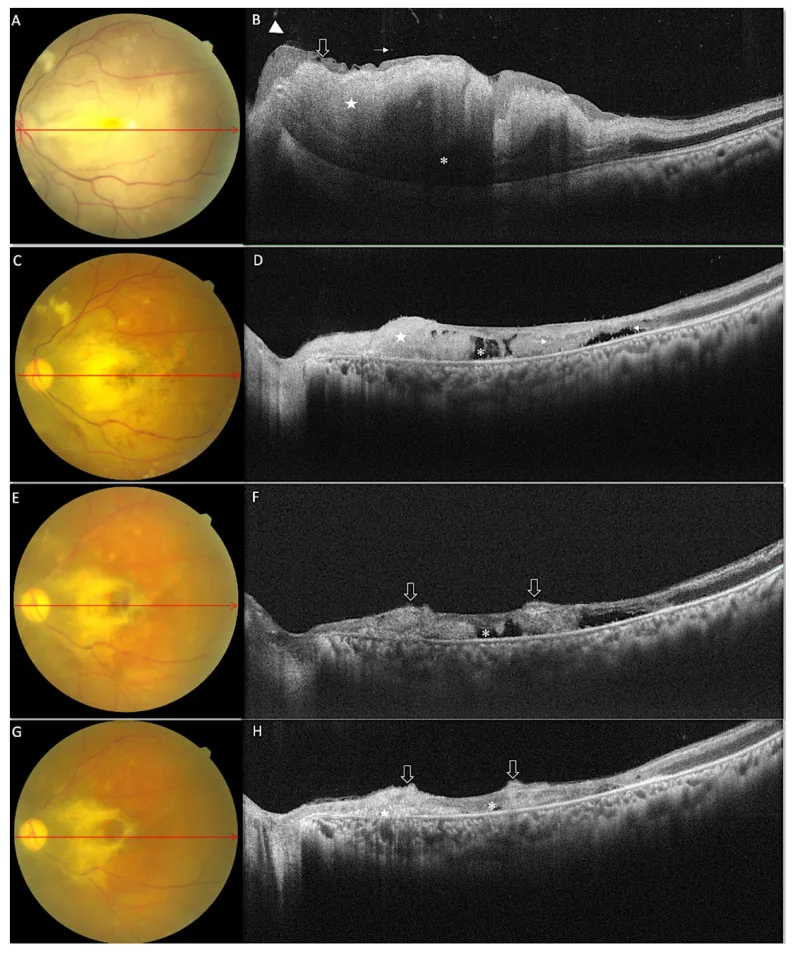 rhino orbital cerebral mucormycosis fundus sd oct