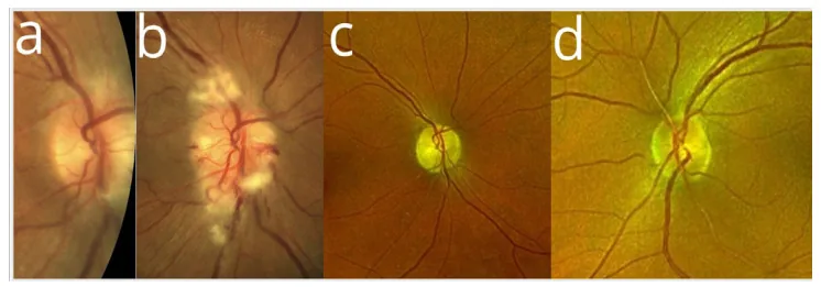 semaglutide associated naion fundus series