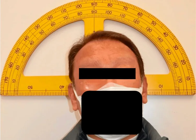 Fotografia clínica da posição compensatória da cabeça na paralisia do quarto nervo craniano