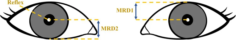 MRD-1とMRD-2の測り方を示した眼の模式図。瞳孔中央の角膜反射(Reflex)を基準に、右側の眼では上眼瞼縁までの縦距離をMRD1、左側の眼では下眼瞼縁までの縦距離をMRD2として青い矢印で示している。