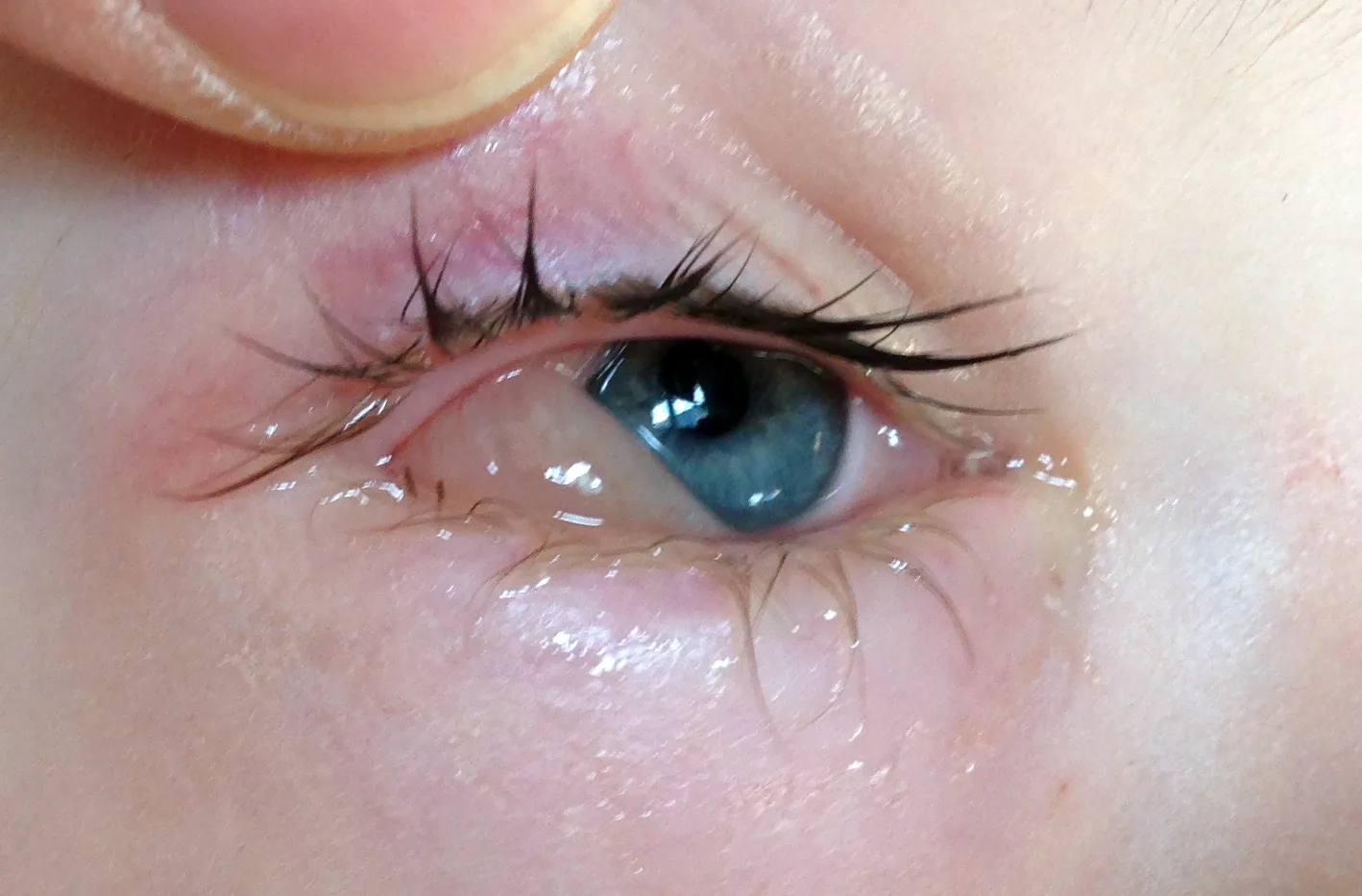 花粉アレルギーによる結膜浮腫（chemosis）：下眼瞼縁から球結膜が膨隆・脱出している状態