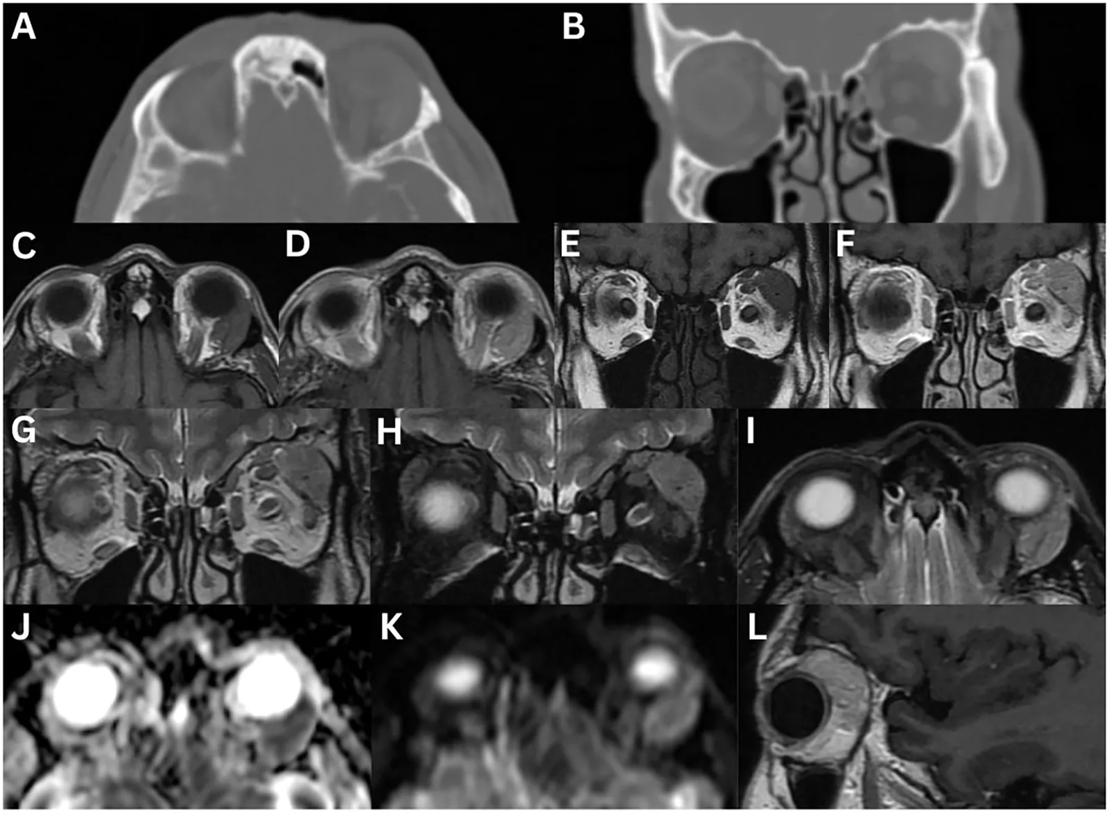 IgG4-assoziierte Dakryoadenitis: isolierte Vergrößerung der linken Tränendrüse im CT (keine Knochenveränderungen) und MRT (T1/T2/Kontrastmittel)