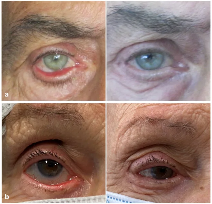 Fotografia clinica preoperatoria di ectropion legato all'età: eversione del bordo palpebrale inferiore ed esposizione della congiuntiva