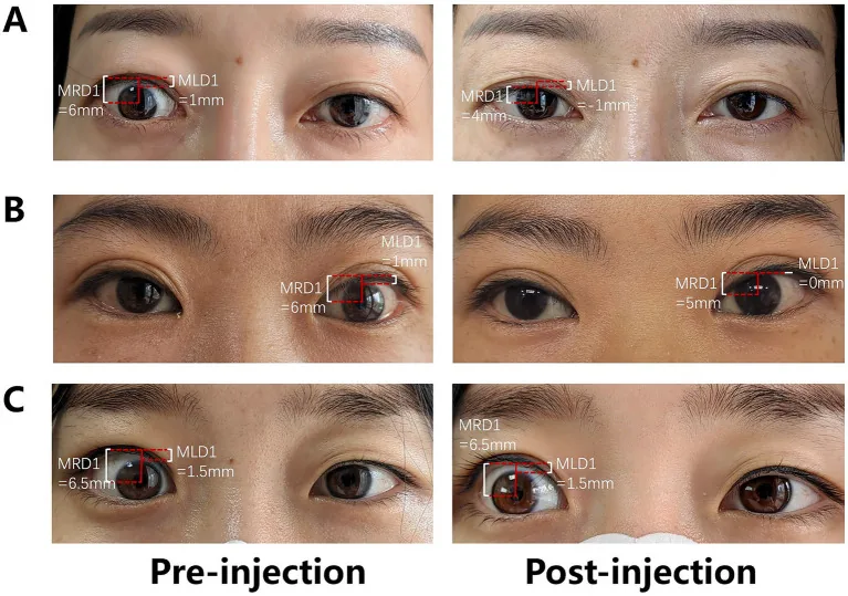 上眼瞼後退の臨床写真：MRD1 6〜6.5mmの強膜露出（scleral show）を示す3症例の注射前後比較