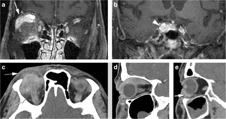 特発性眼窩炎症のMRI・CT：多焦点性病変と筋腱付着部を含む外眼筋腫大