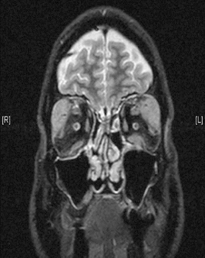 МРТ двустороннего увеличения слезных желез при IgG4-ассоциированном заболевании глаз: смещение наружных глазных мышц и глазного яблока увеличенными слезными железами