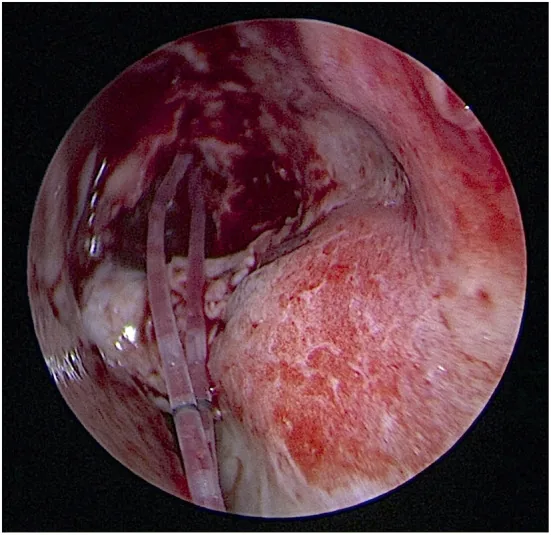 Technique d'insertion d'un tube en silicone à double bras (stent lacrymal à deux tubes de type Nunchaku) passé des deux points lacrymaux vers la cavité nasale