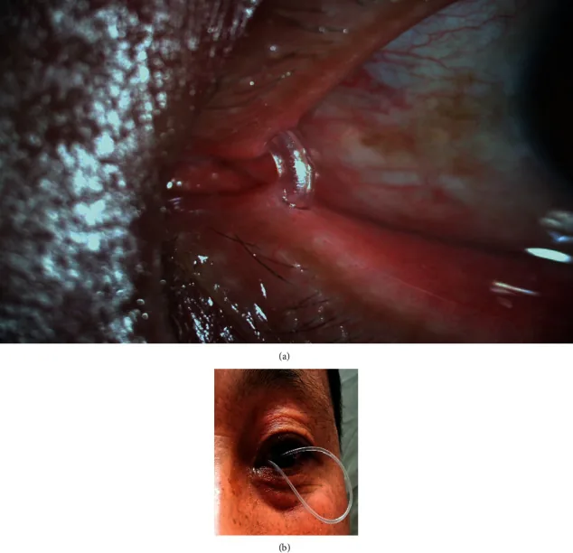 Image clinique d'un tube en silicone faisant une boucle et faisant saillie du canthus interne (prolapsus sévère du tube)