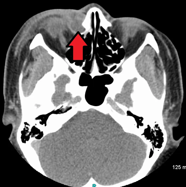 تصویر CT از التهاب کیسه اشکی ناشی از انسداد مجرای اشکی-بینی: بزرگ شدن کیسه اشکی و تغییرات التهابی بافت نرم اطراف