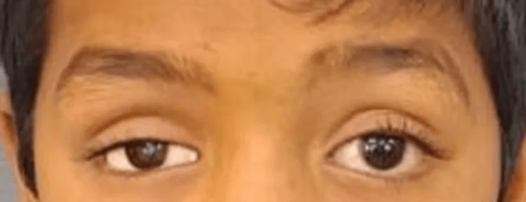 義眼を装用した小児の目元の写真。両眼の虹彩の色と大きさ、まぶたの開きがほぼ左右対称で、一見して義眼側が分かりにくい。