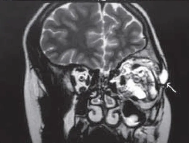 眼窩リンパ管腫のMRI T2冠状断像：多胞性囊胞性腫瘤