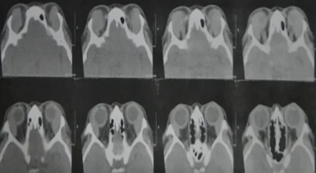 眼窩リンパ腫の軸位CT：骨侵食のない均質な腫瘤が眼窩構造に沿う（moldingパターン）