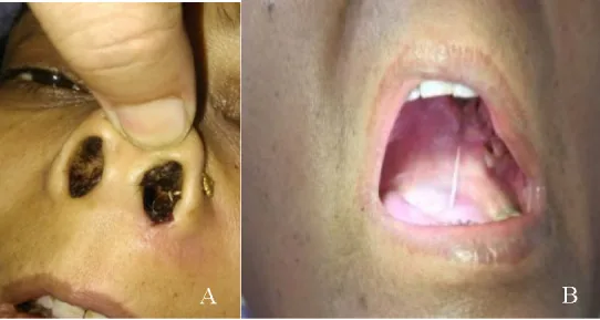 鼻前庭の黒色壊死性痂皮（black eschar）と口蓋粘膜壊死